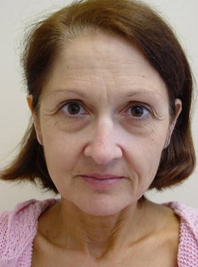 Facelift in San Francisco Patient Before 1