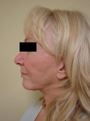 Facelift in San Francisco Patient Before 3