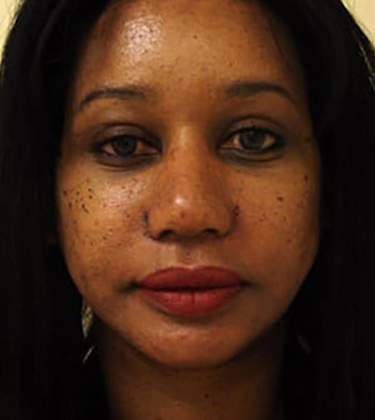 Ethnic Rhinoplasty in San Francisco Patient After 4