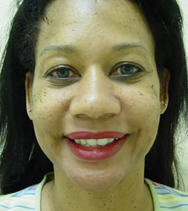 Ethnic Rhinoplasty in San Francisco Patient Before 3