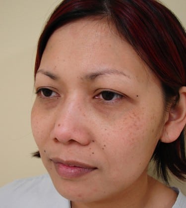 Ethnic Rhinoplasty in San Francisco Patient Before 1