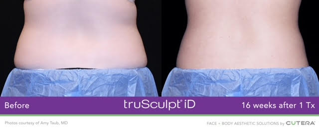 TrueSculpt actual patient results