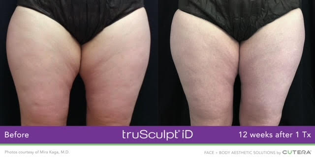 TrueSculpt actual patient results Before and After