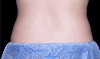 truSculpt® 01 Patient After
