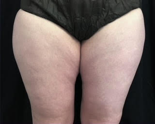 truSculpt® 03 Patient After