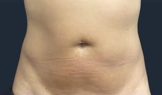truSculpt® 04 Patient After