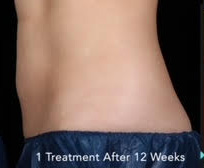 truSculpt® 05 Patient After