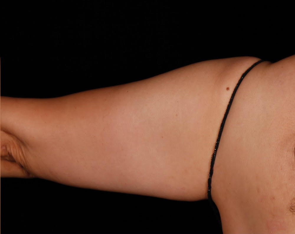 truSculpt® Patient After 4