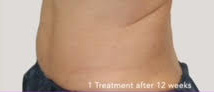 truSculpt® 07 Patient After