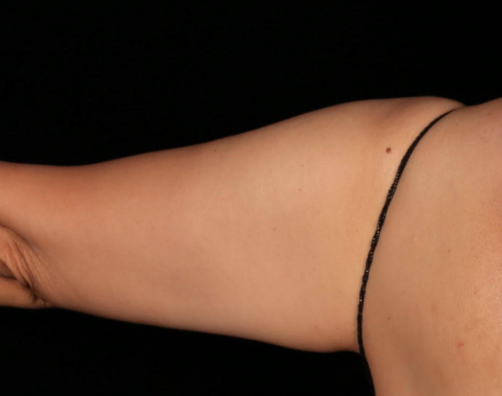 truSculpt® Patient Before 3