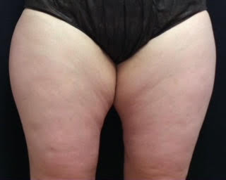 truSculpt® 03 Patient Before