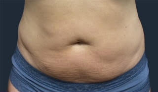 truSculpt® 04 Patient Before