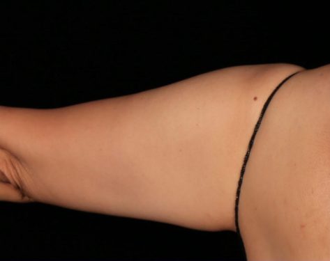 truSculpt® 06 Patient Before