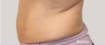 truSculpt® 07 Patient Before