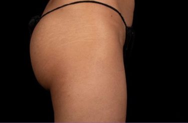 truSculpt® 08 Patient After
