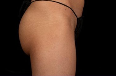 truSculpt® 08 Patient Before