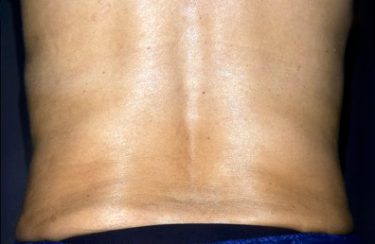 truSculpt® 10 Patient After