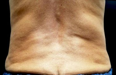 truSculpt® 10 Patient Before
