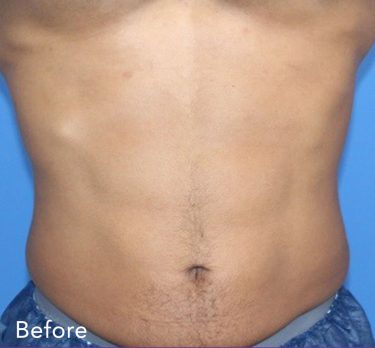 truSculpt® 12 Patient Before