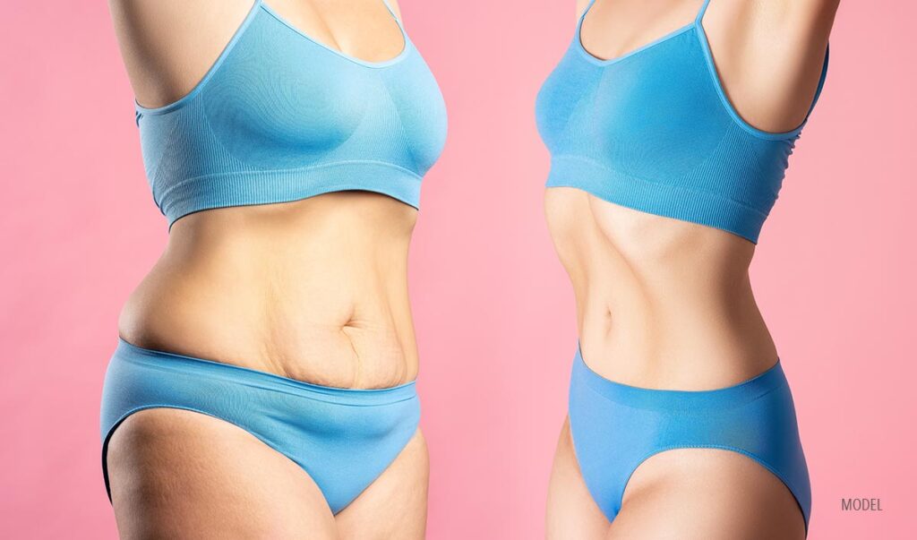 A before and after of a woman who underwent a tummy tuck.
