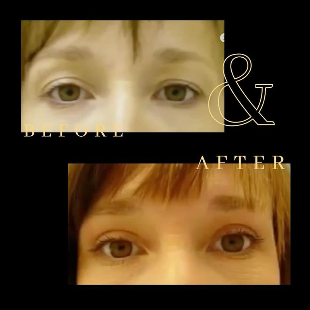 Eyelid lift patient results