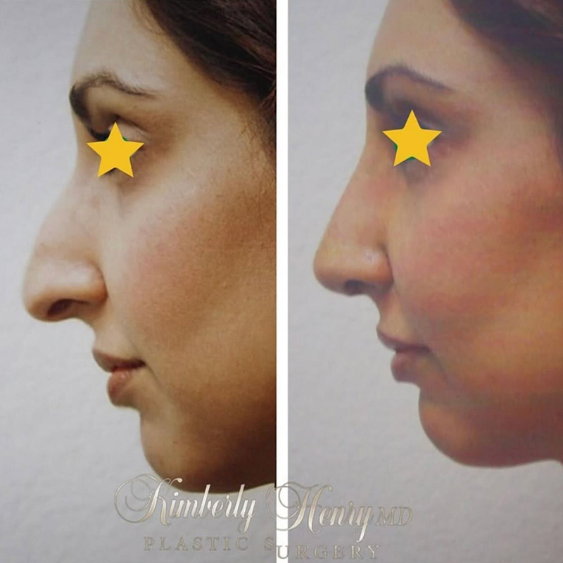 Instagram Before and After Post 1