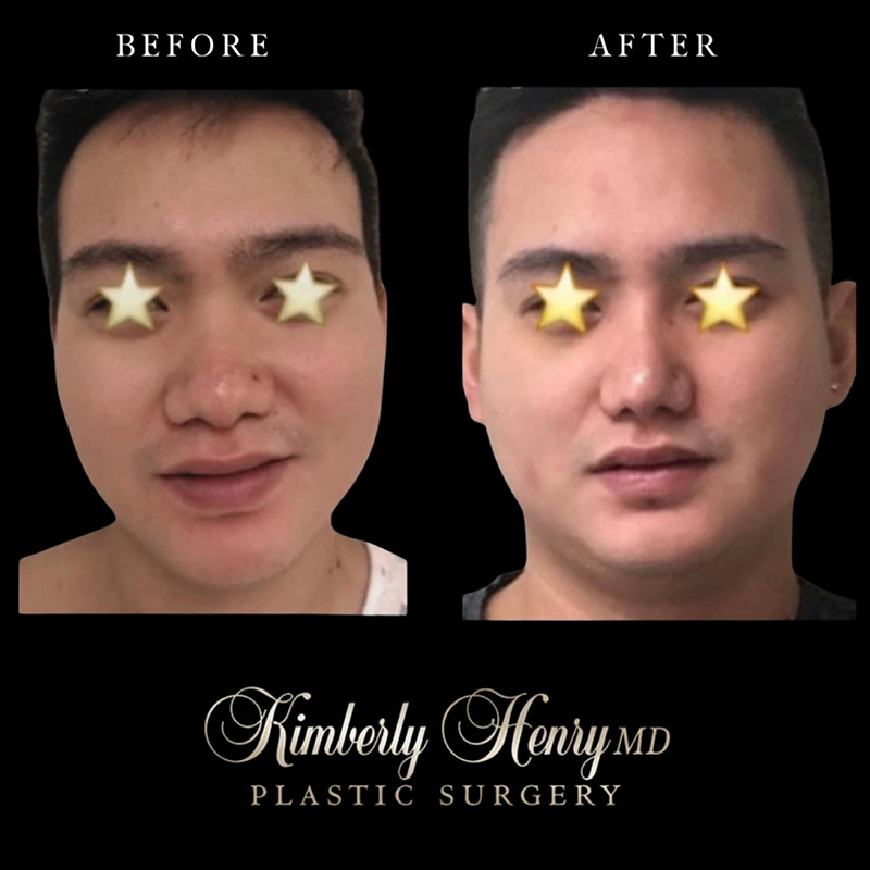 Instagram Before and After Post 4