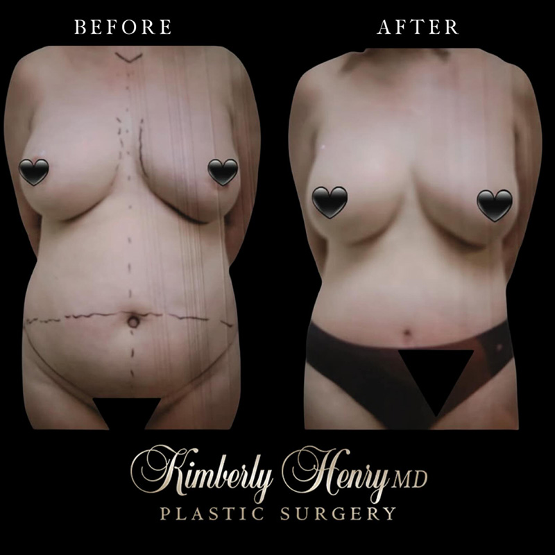 Instagram Tummy Tuck Post 5