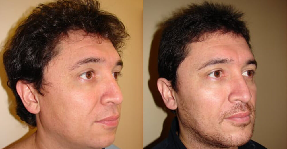 Chin enlargement patient results