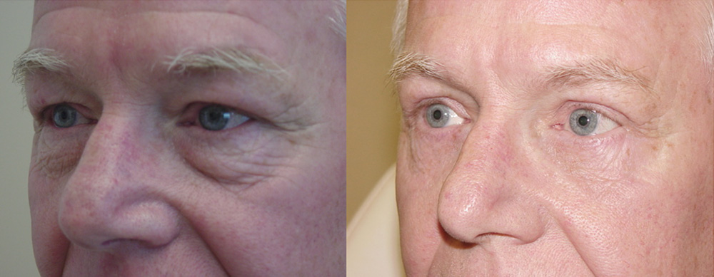 Eyelid Lift patient results