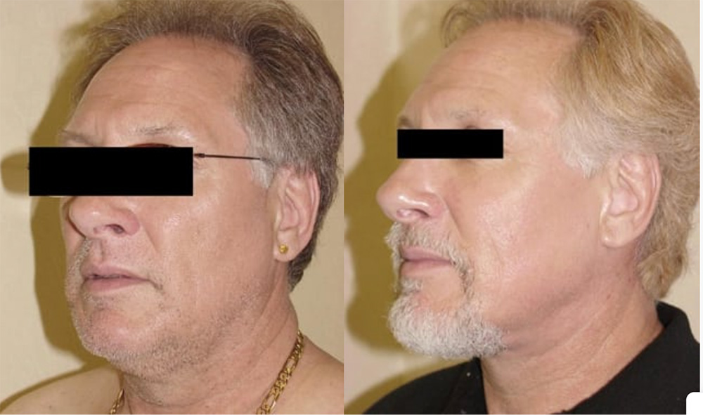 Facelift patient results