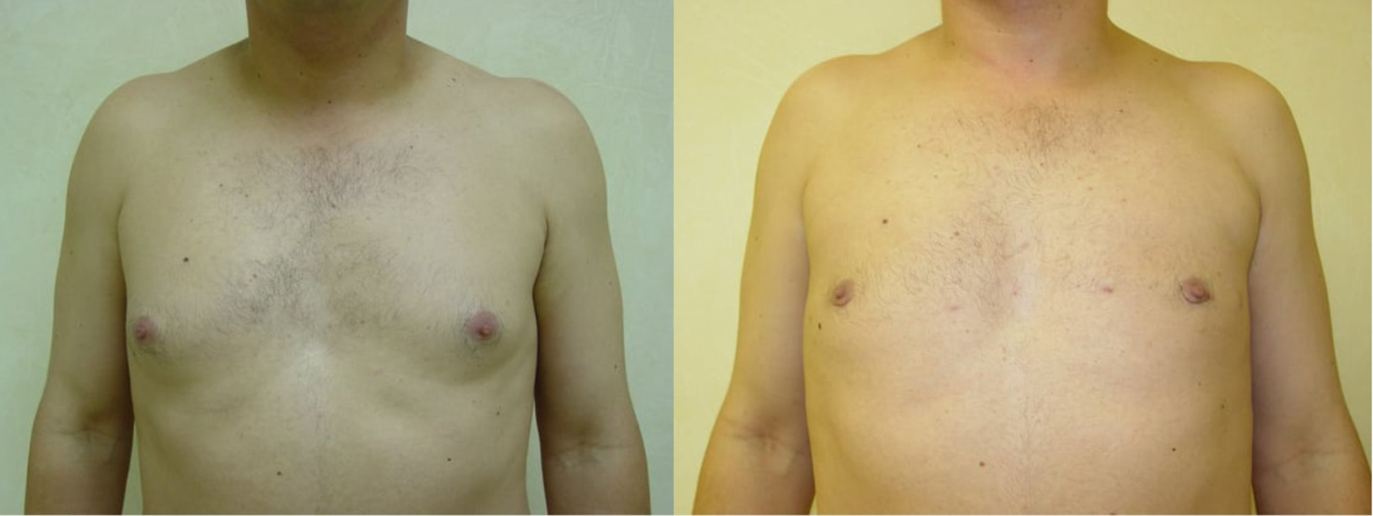 Gynecomastia Results