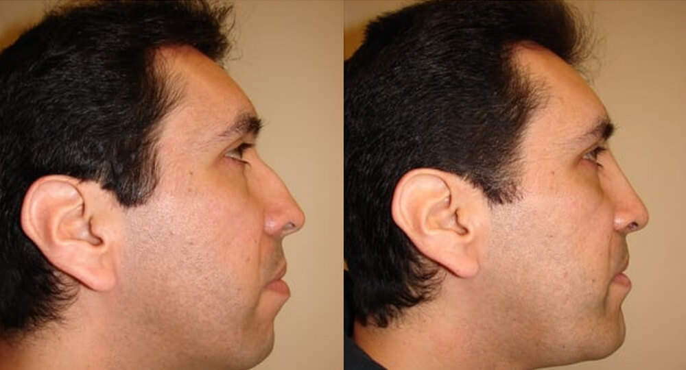 Rhinoplasty patient results