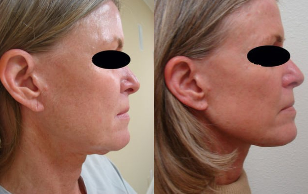 Actual patient results