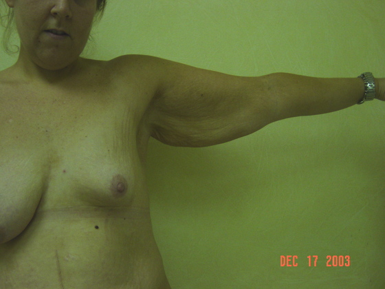 Case--5356 | Before Body