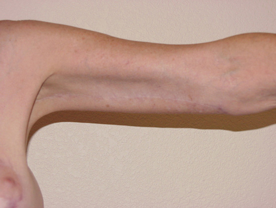 Case--6341 | After Body