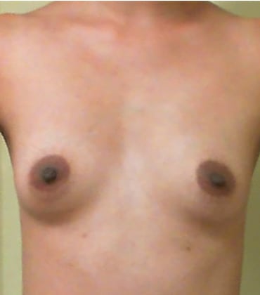 Case--2286 | Before Breast Augmentation