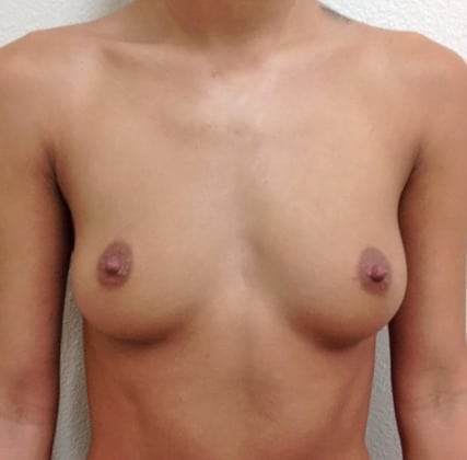 Case--1994 | Before Breast Augmentation