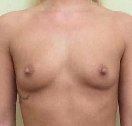 Case--5729 | Before Breast Augmentation
