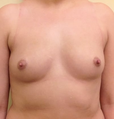 Breast-Augmentation-Case--1874 | Before Breast Augmentation