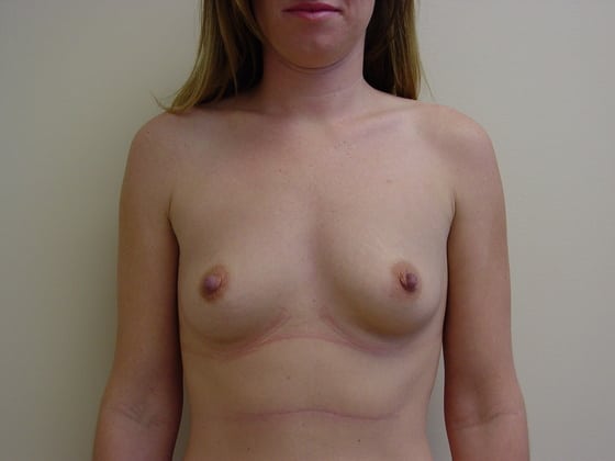 Case--5779 | Before Breast