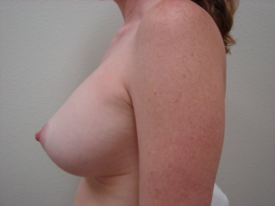 Case--7969 | After Breast Implants