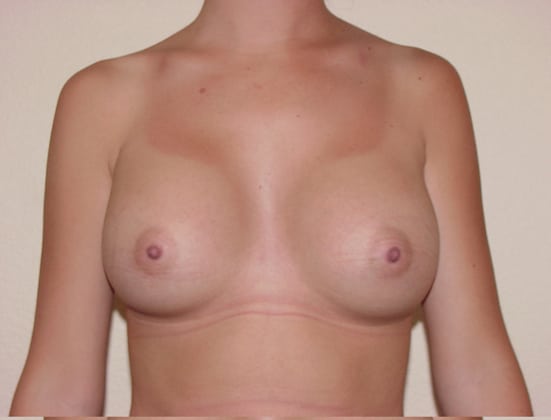 Case--4229 | After Breast Implants