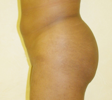 Case--8071 | Before Brazilian Butt Lift