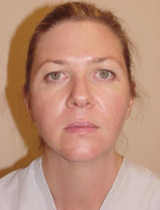 Case--8452 | Before Face