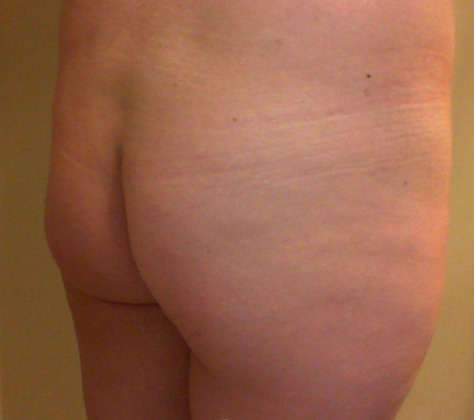 Case--9104 | Before Brazilian Butt Lift