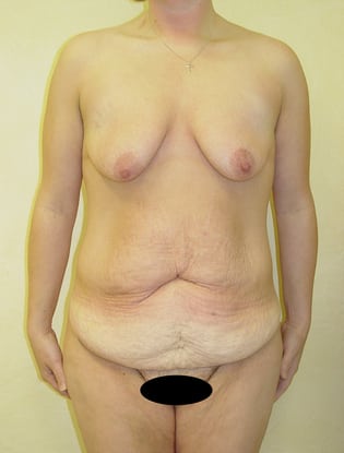 Case--5213 | Before Tummy Tuck