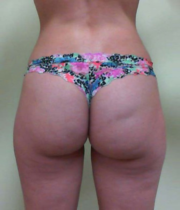 Case--4772 | Before Brazilian Butt Lift