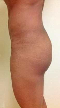 Case--3057 | Before Brazilian Butt Lift