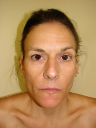 Brow-Lift-Case--4737 | Before Face